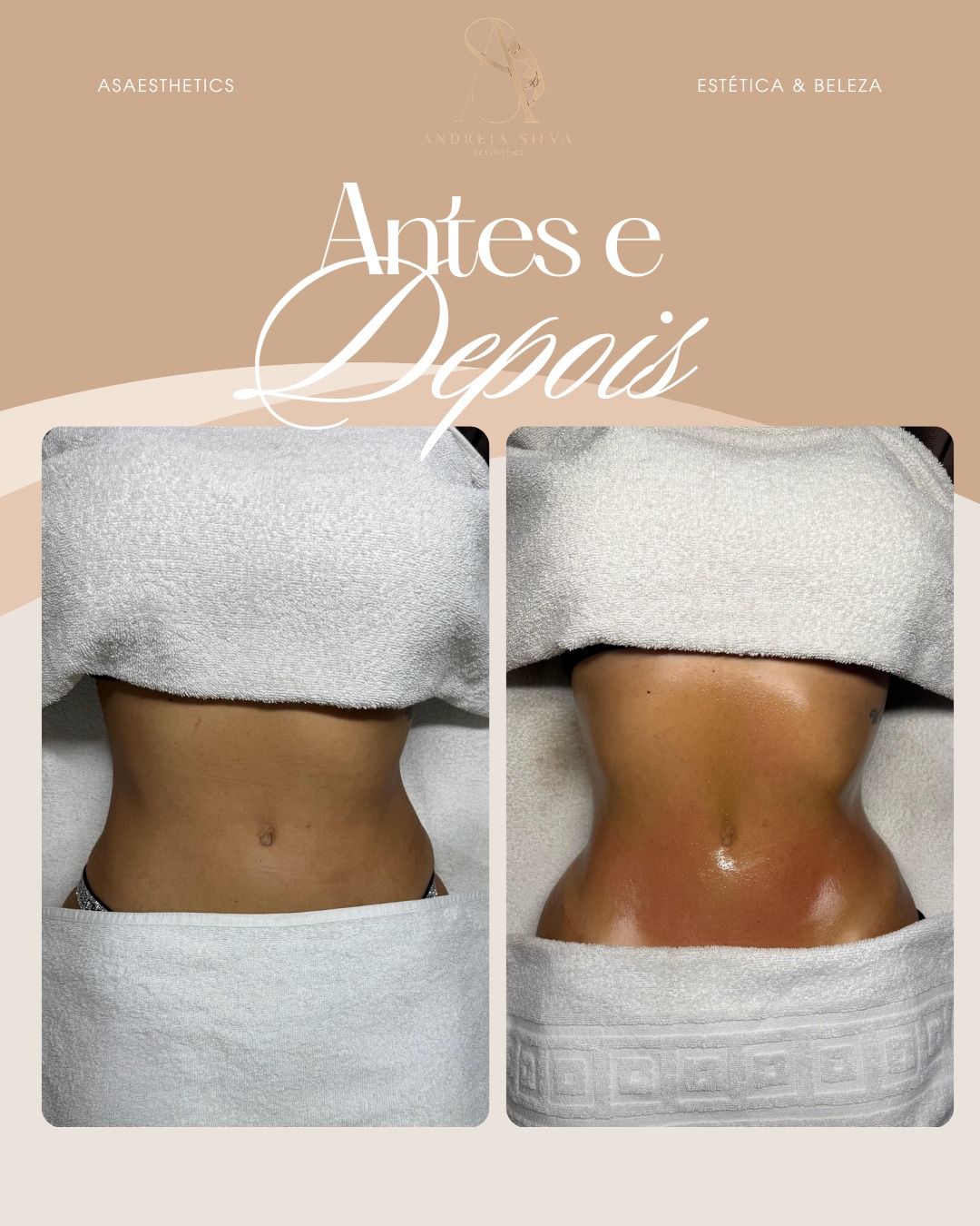 Antes e depois — abdómen