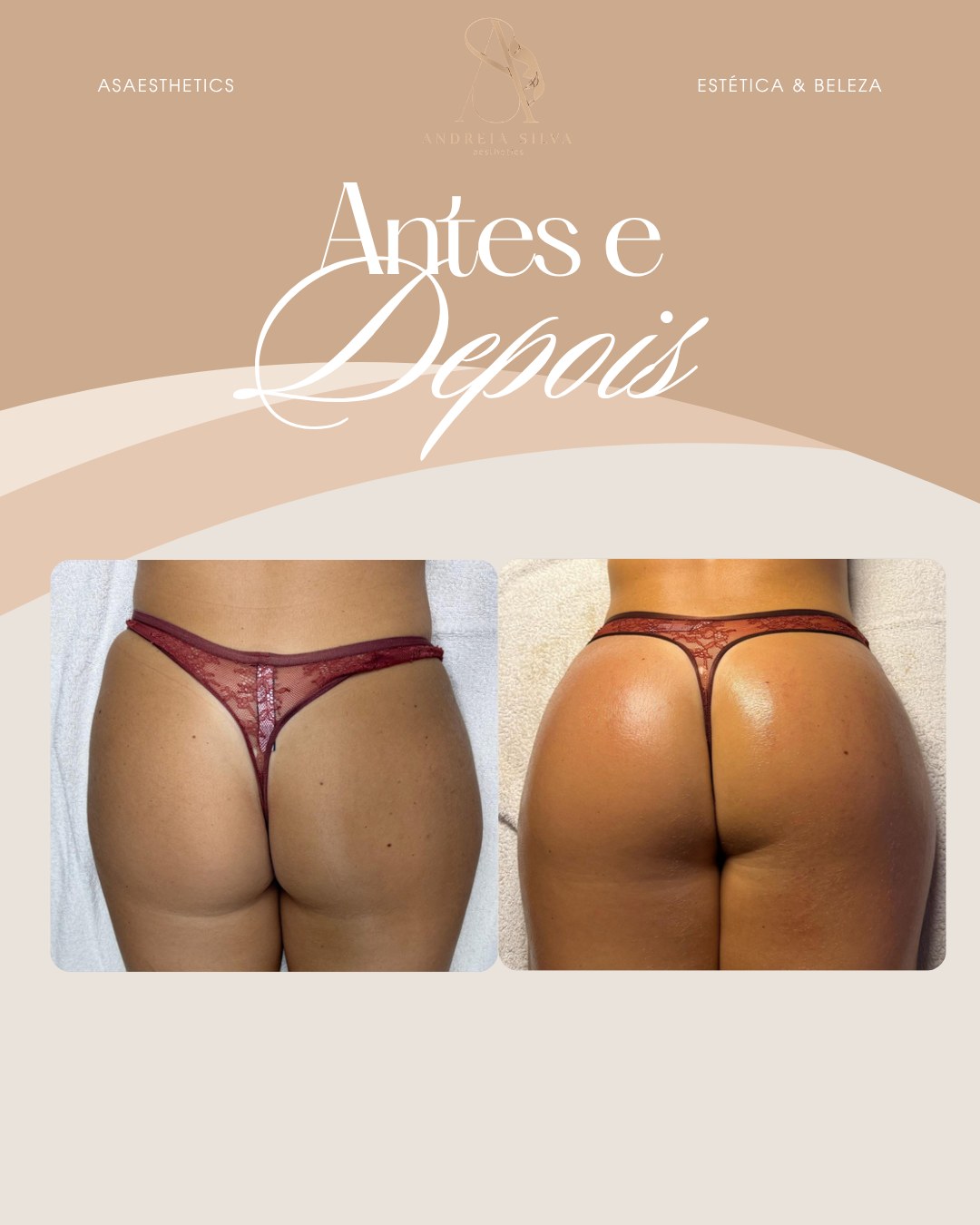 Antes e depois — glúteos