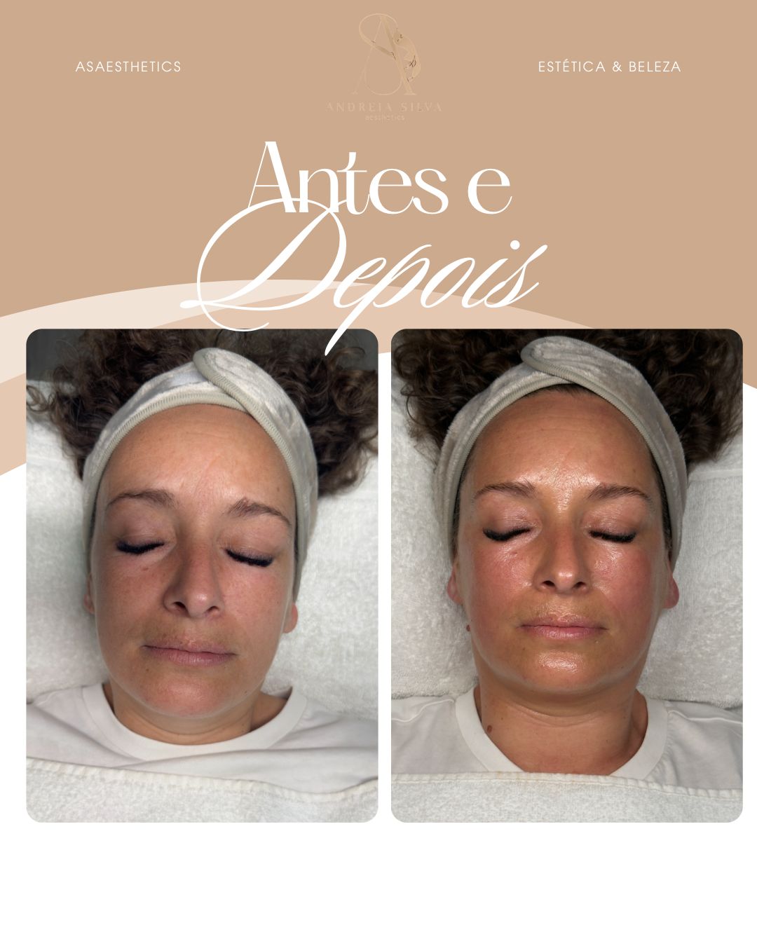 Antes e depois — rosto