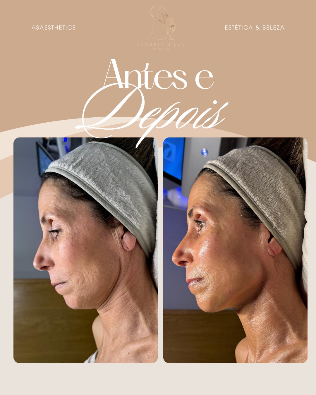 Antes e depois — rejuvenescimento facial